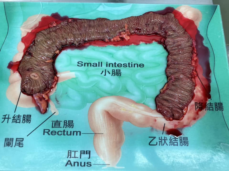women-constipate-operation-80%--large-intestine