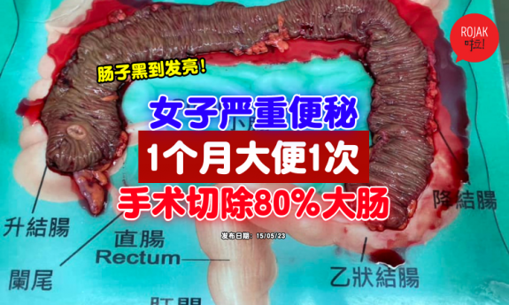 women-constipate-operation-80%--large-intestine