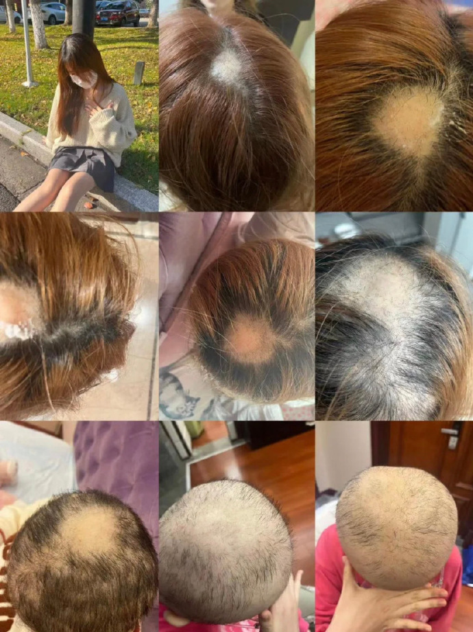 young-girl-dye-hair-become-botak