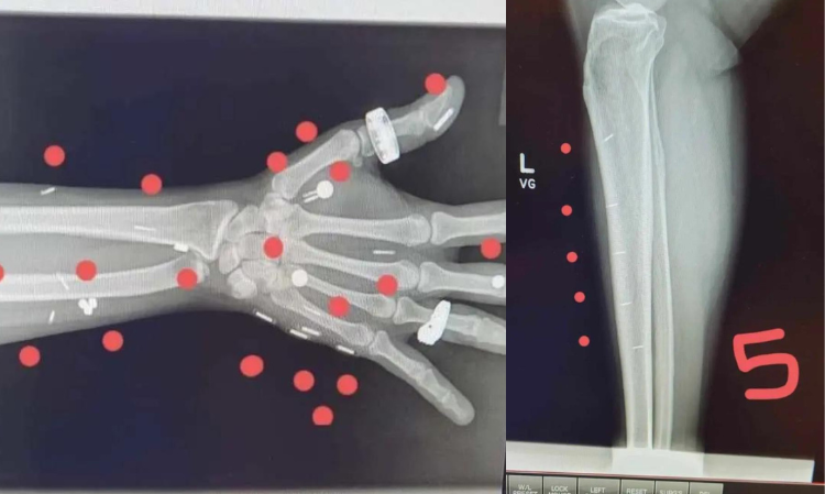 woman-body-52-implants