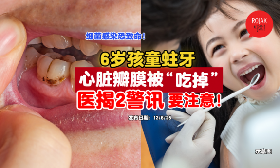 tooth-decay-Infective-endocarditis