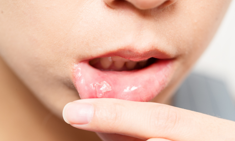 ulcers-reason-3-symptoms-careful-