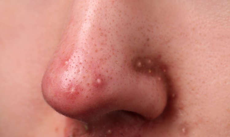 nose-pimple-cancer-