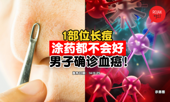 nose-pimple-cancer-