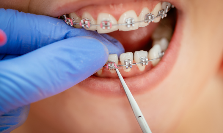 wear-braces-clean-teeth-well