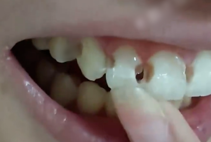 wear-braces-clean-teeth-well