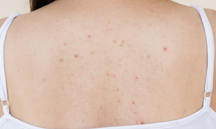back-pimples-reason