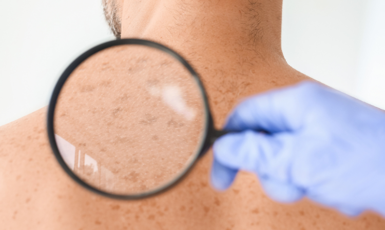 back-pimples-reason