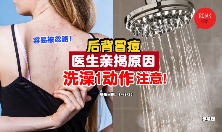 back-pimples-reason