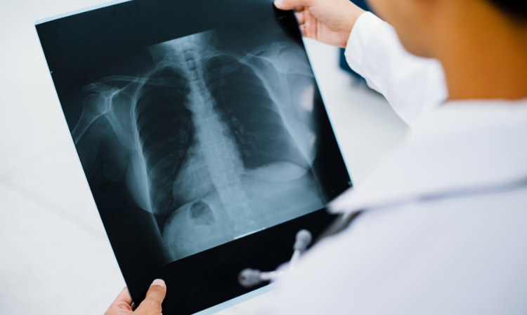 cough-lung-cancer