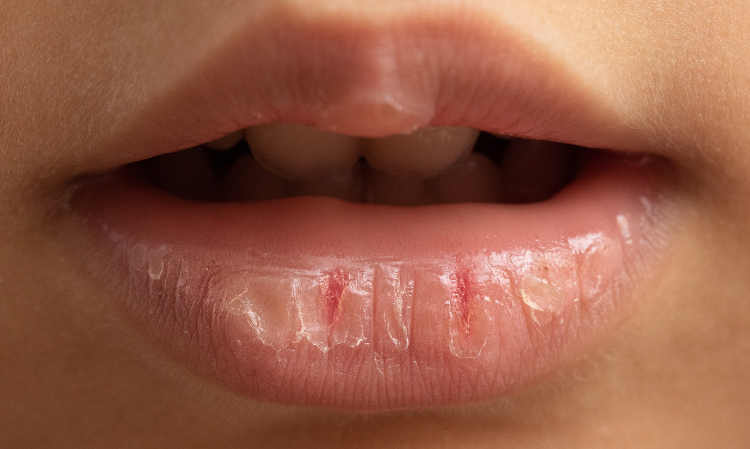 dry-mouth-maybe-sick-symptoms