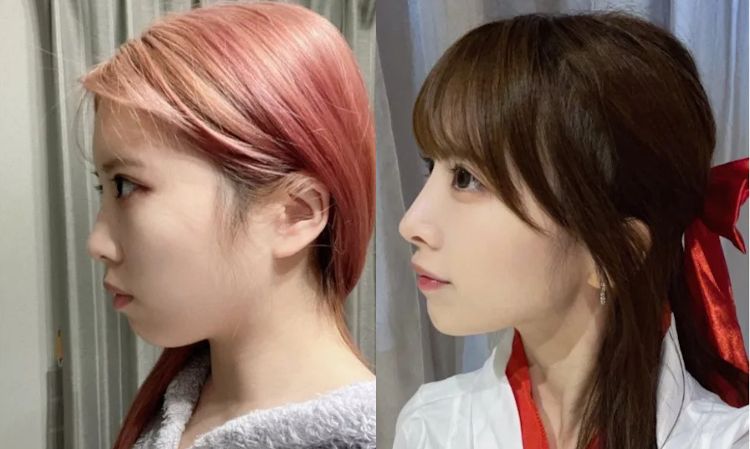 Japanese-idol-plastic-surgery