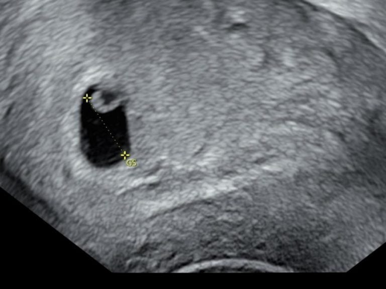 taiwan-Ili-Cheng-Miscarriage