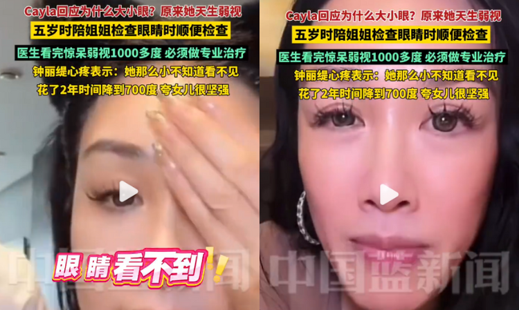Christy-Chung-daughter-has-amblyopia