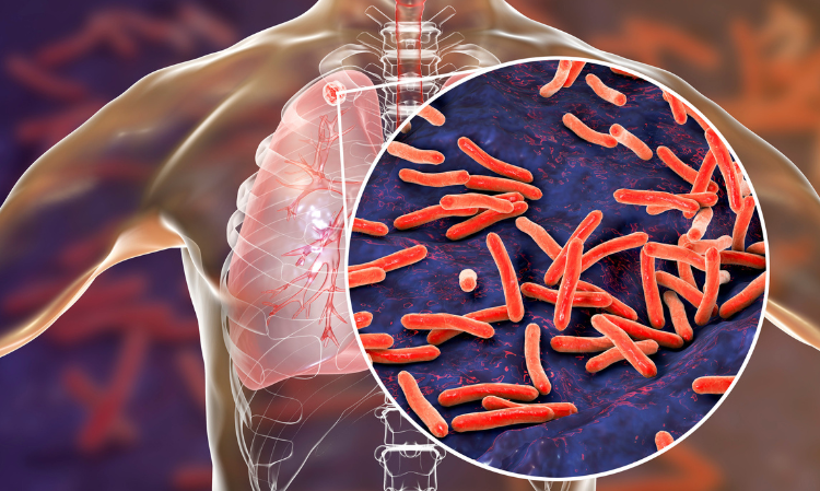 Johor-kota-tinggi-kejadian-wabak-tuberkulosis