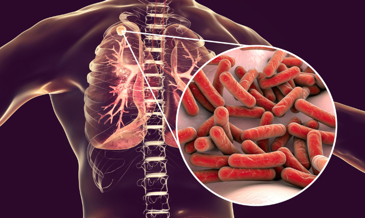 2026-new-TB-infection-cluster-case