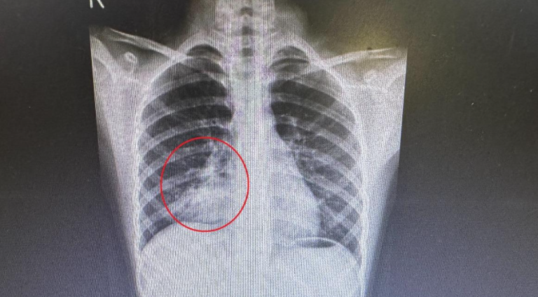 Influenza-A-became-Mycoplasma-pneumoniae