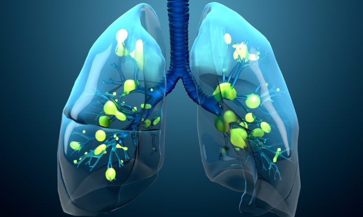 things-to-know-about-pneumonia