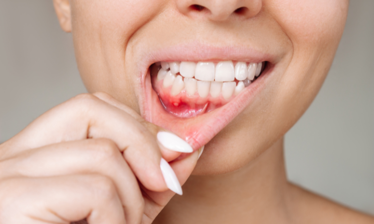 ulcer-hsv-symptoms