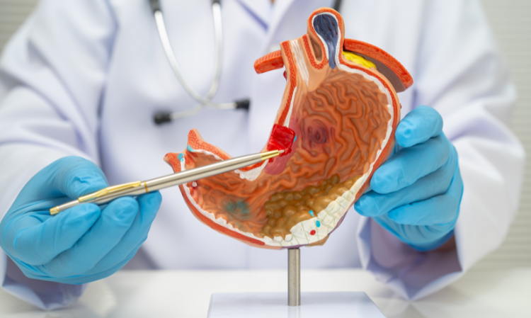 Bloating-gastric-cancer-two-bad-habbits
