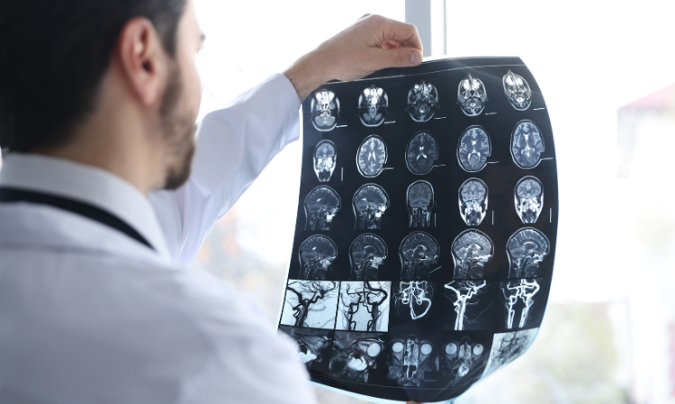 the-symptoms-of-stroke