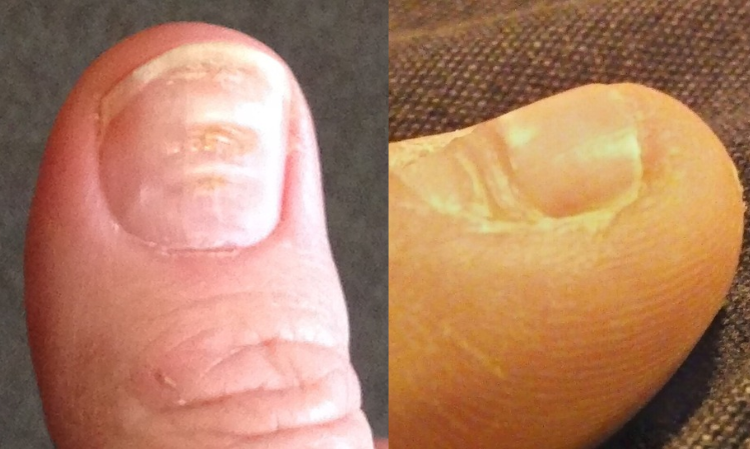 nails-unusual-condition-End-Stage-Renal-Disease-