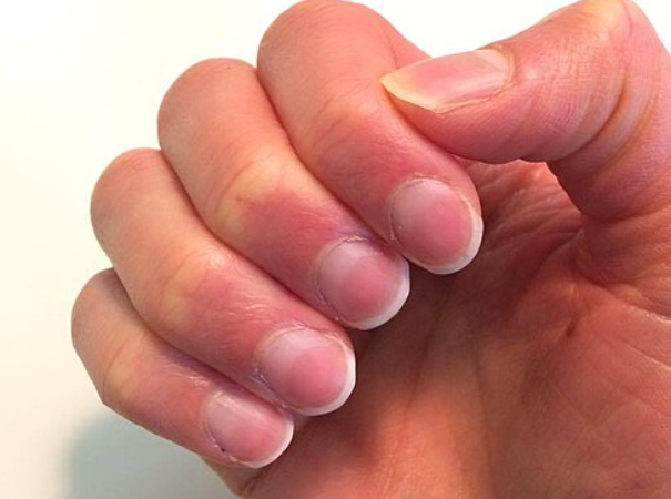nails-unusual-condition-End-Stage-Renal-Disease