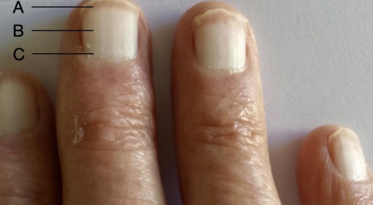 nails-unusual-condition-End-Stage-Renal-Disease