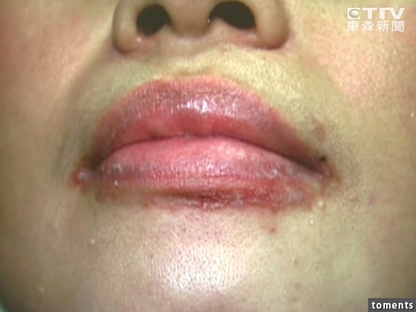 unhealthy lip (9)
