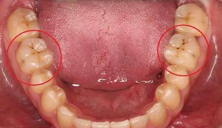 牙齿发育沟图片图片