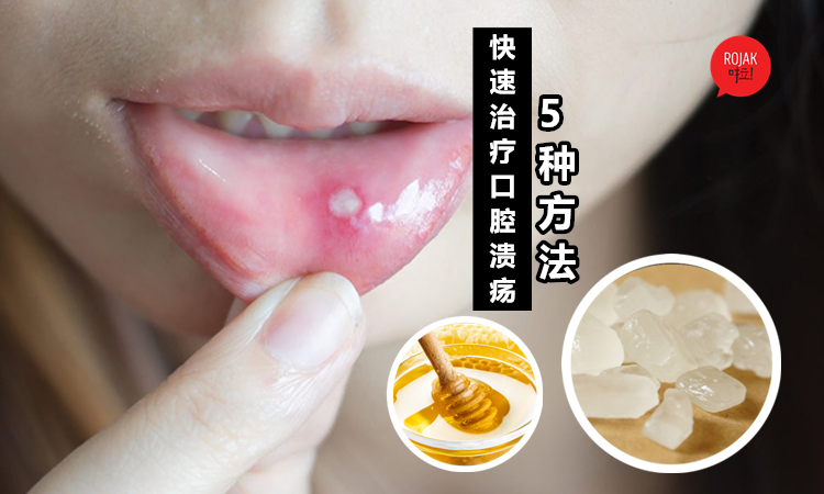 嘴巴又出现ulcer 5招教你赶走嘴巴的白点 不看医生也能神速痊愈 超神奇
