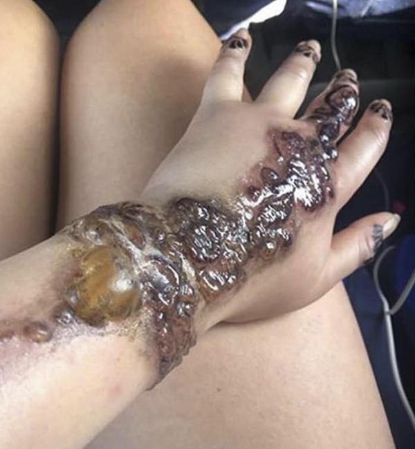 画上henna纹身数小时后,澳洲女子感到皮肤发痒,手上更冒起含脓水泡