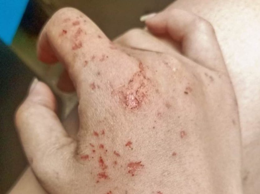 蟑螂咬人后的伤口图图片